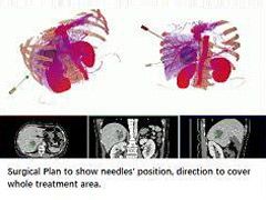 Surgical planning