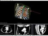 Percutaneous ablation